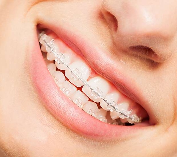 Clear Braces in Staten Island, NY