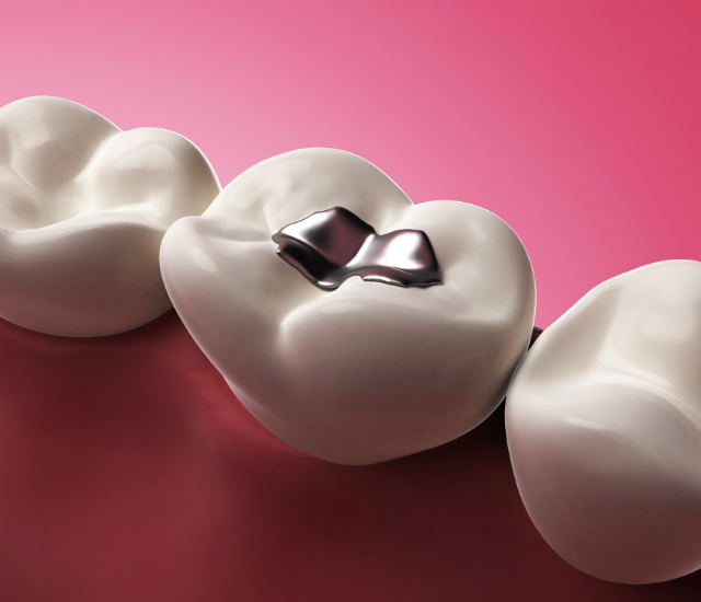 Dental Fillings : What Is The SMART Amalgam Removal Technique?