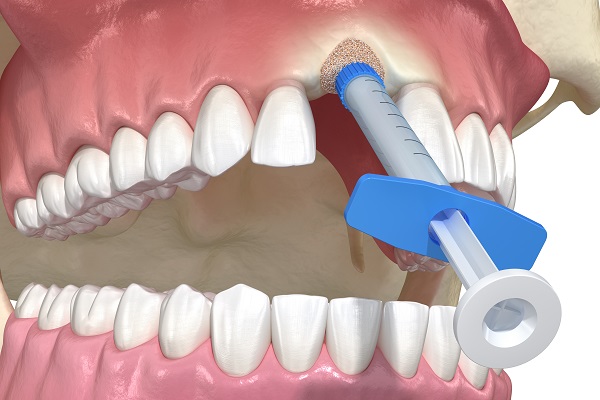 Pros And Cons Of Bone Grafting