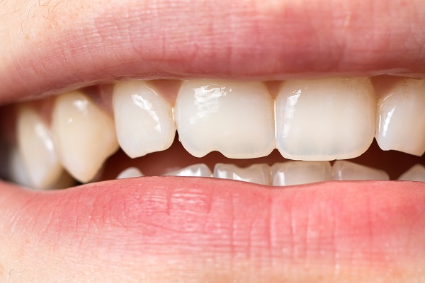 Why It Is Important To Repair A Chipped Tooth