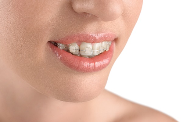 Consider Clear Braces for Straighter Teeth - RSN Dental PC Staten Island  New York