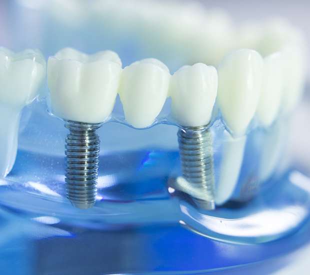 Staten Island Dental Implants