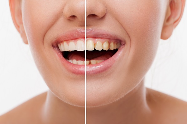 Dental Restoration After An Auto Accident