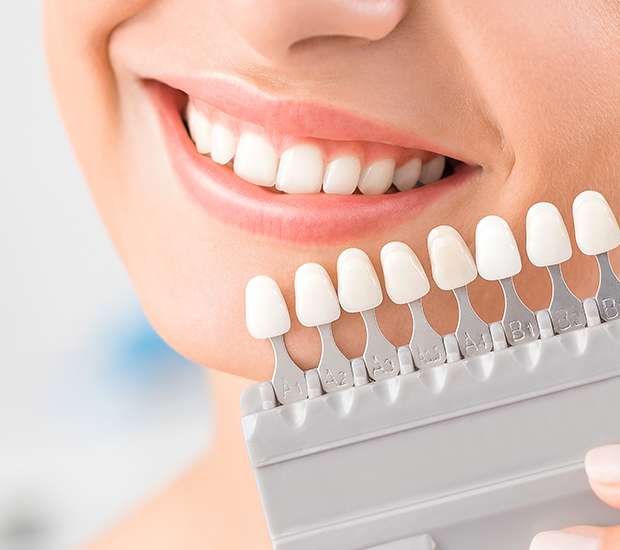 Staten Island Dental Veneers and Dental Laminates