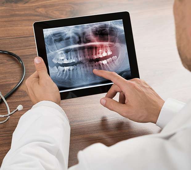 Staten Island Types of Dental Root Fractures